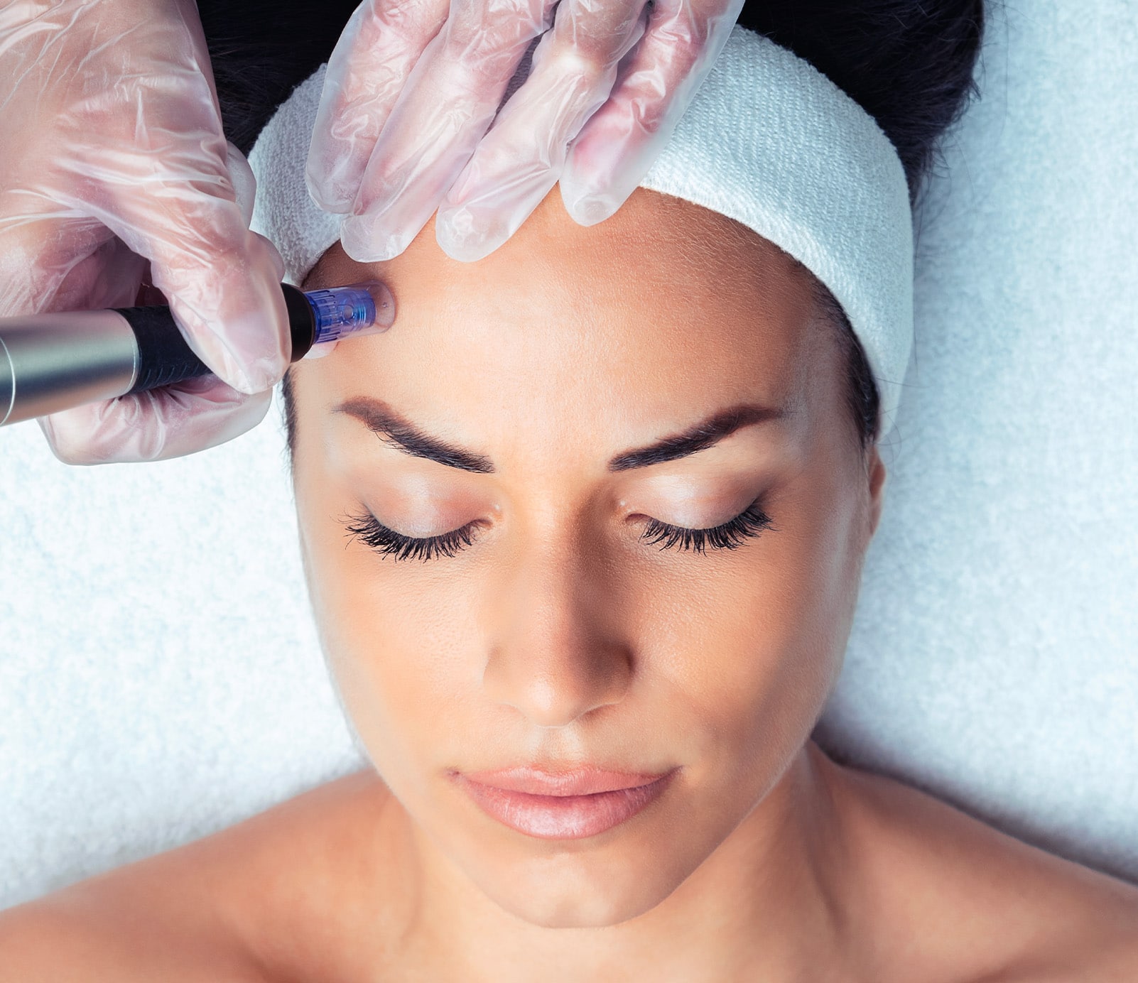 Microneedling-bruxelles