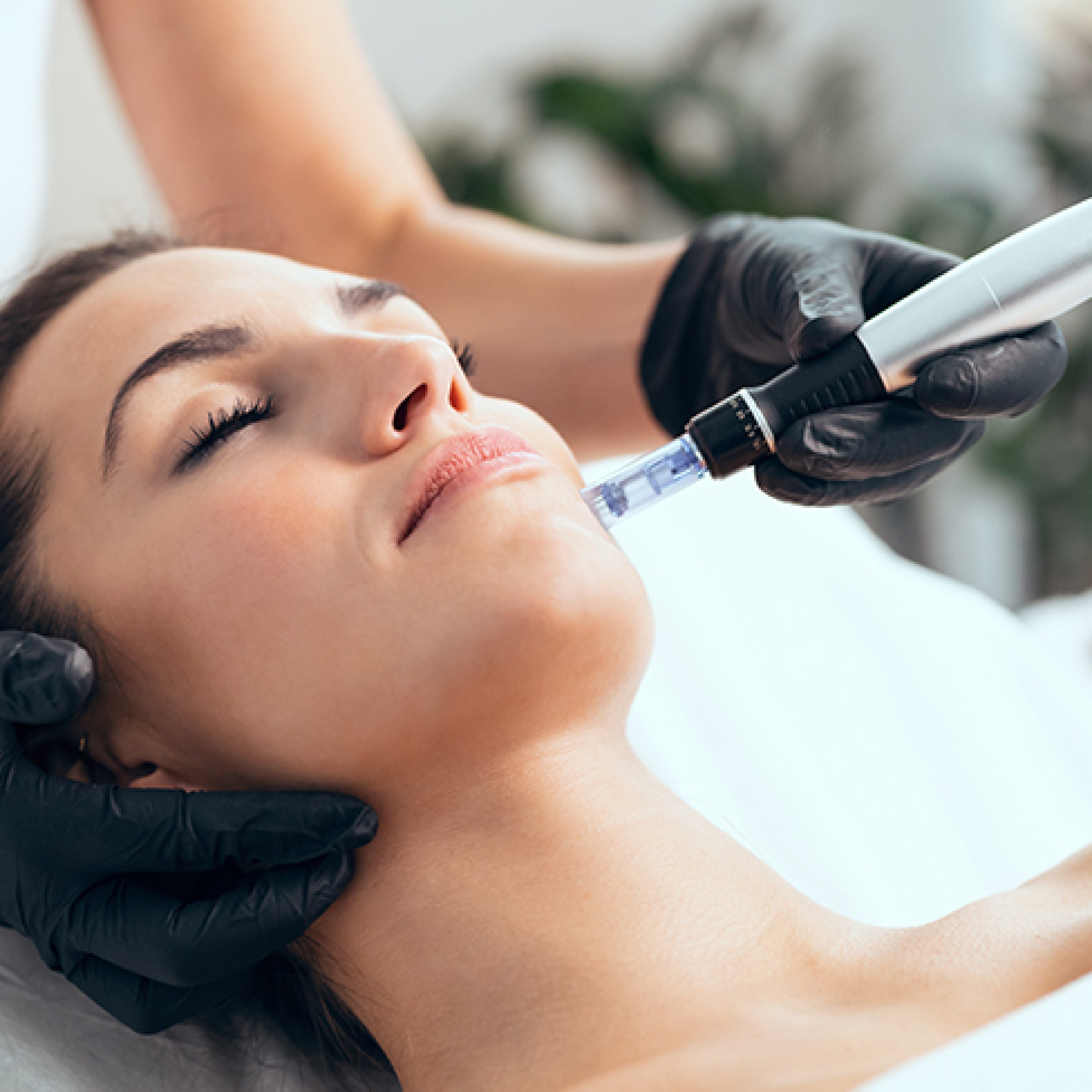 microneedling
